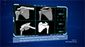 Robotic Shoulder Replacement