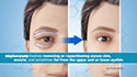 Blepharoplasty