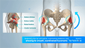 Gluteal Repair