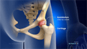 Hip Cartilage Injuries