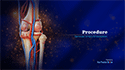 Genicular Artery Embolization