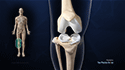 Knee Meniscectomy