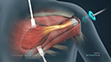 Arthroscopy-Assisted Lower Trapezius Transfer