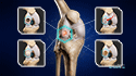 Knee Cartilage Repair