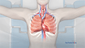 Lung Transplant