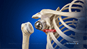 Reverse Total Shoulder Replacement