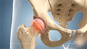 Slipped Capital Femoral Epiphysis