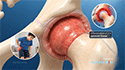 Hip Synovitis