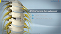 Artificial Cervical Disk Replacement