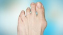 Bunion Surgery