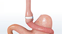GABP Ring Implantation
