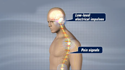 Neuromodulation Neuromodulation