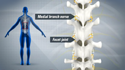 Rhizotomy Rhizotomy