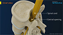 Spinal Stenosis