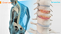 Spondylosis Spondylosis